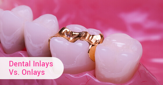 Dental Inlays Vs. Onlays