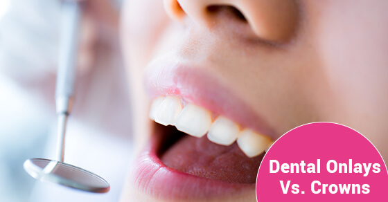 Dental Onlays Vs. Crowns