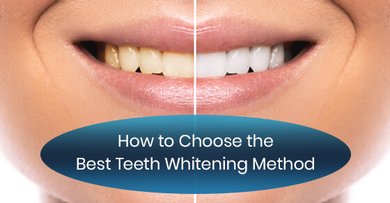 How to Choose the Best Teeth Whitening Method | Dawson Dental