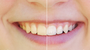 veneer before and after 2