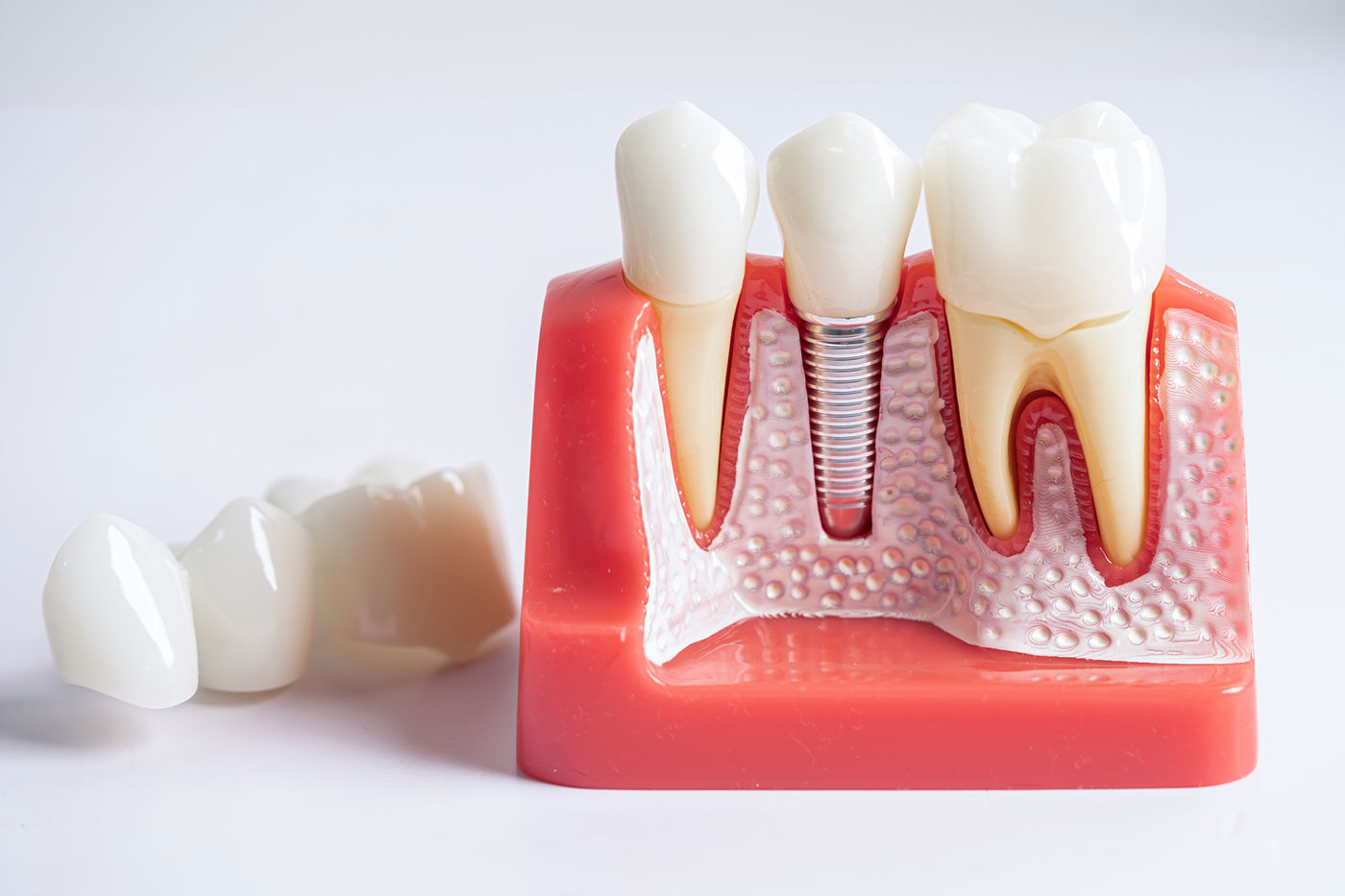 Kitchener Dental Implants
