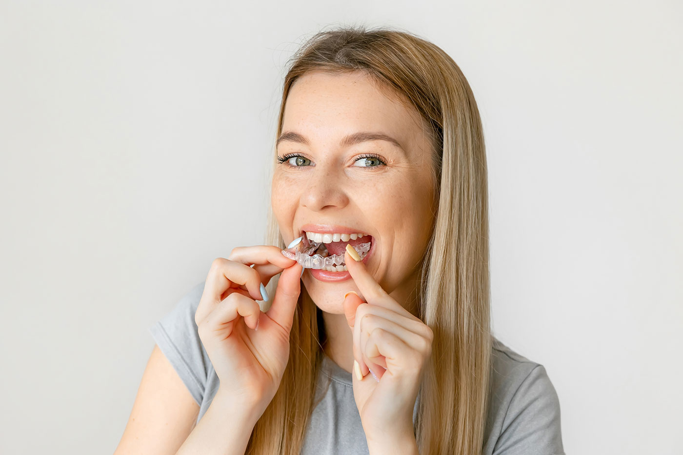 invisible braces